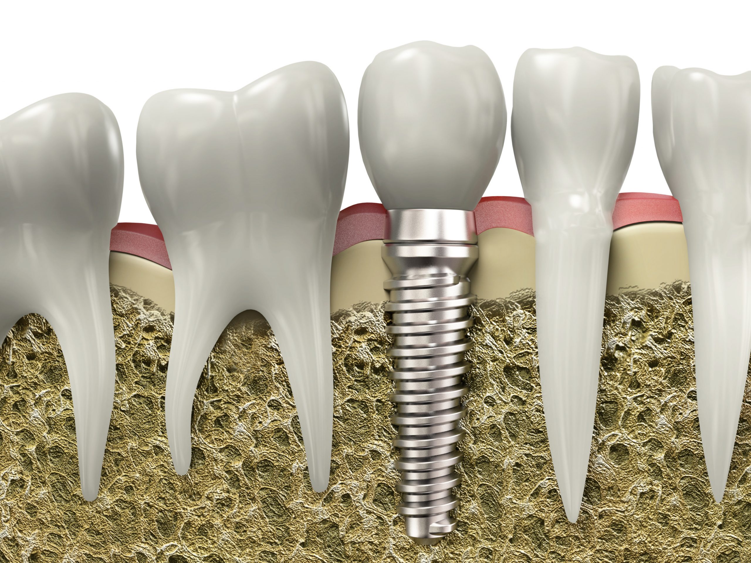 Affordable Dental Implants: A Comprehensive Guide