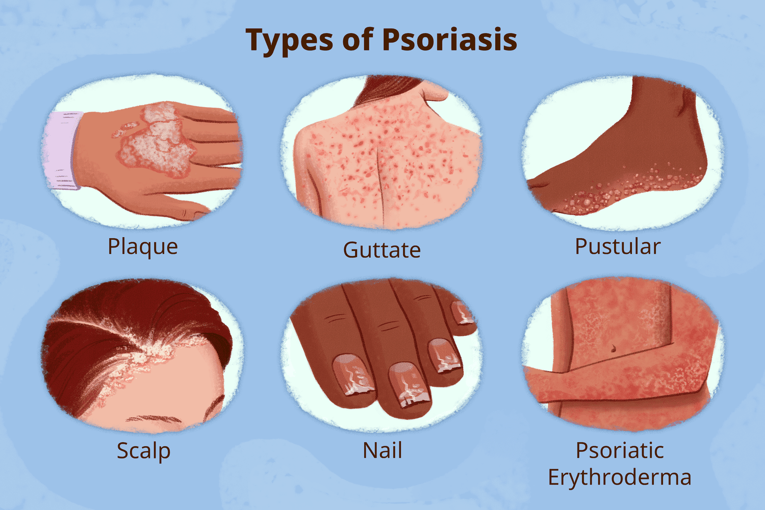 Do You Know These Signs Of Plaque Psoriasis?