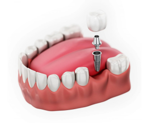 The most complete guide to dental implant costs in 2025