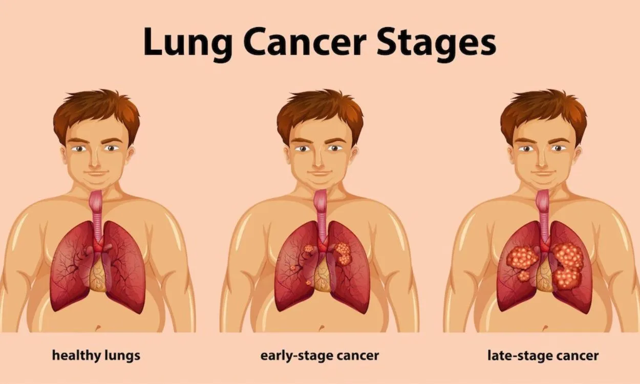 6 Early Signs of Lung Cancer that Cannot Be Ignored