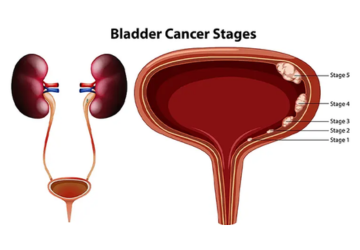 Bladder Cancer: Causes, Symptoms, and Prevention