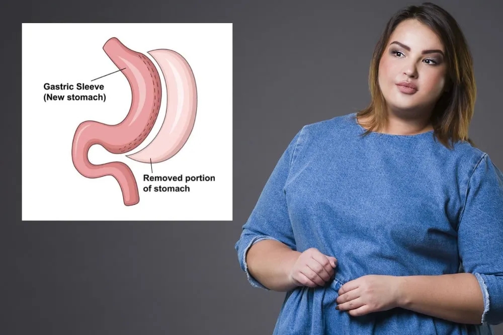 Reshaping the curve of life: the art and science of sleeve gastrectomy