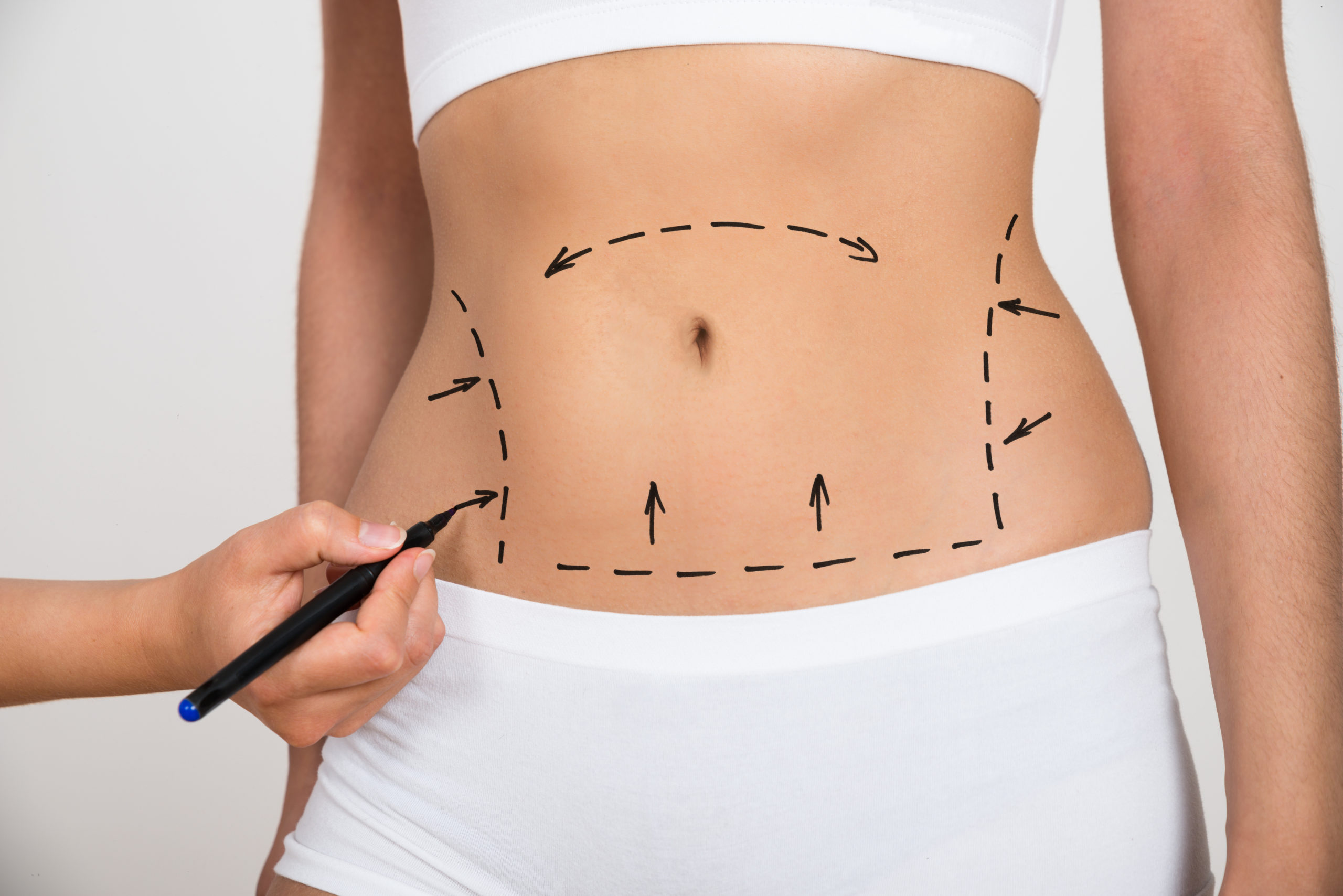 Affordable Liposuction Surgery: A Comprehensive Guide