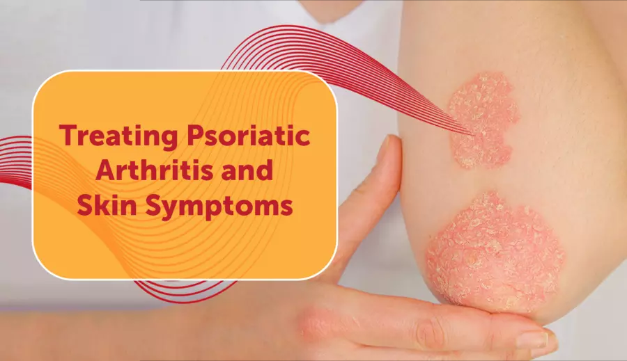 5 Early Symptoms of Psoriatic Arthritis & Effective Management Options!