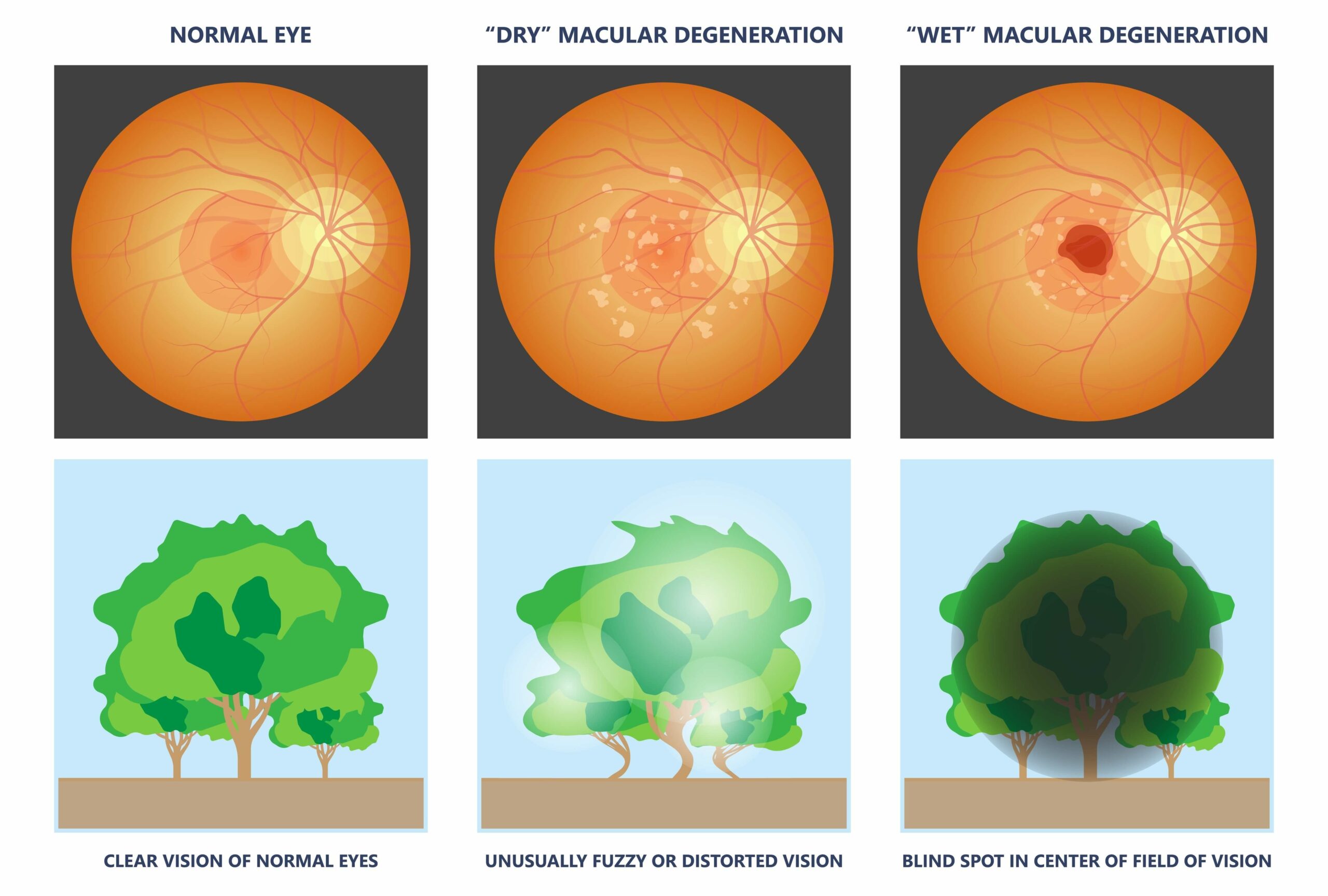 Macular Degeneration Treatment: Comprehensive Solutions for Eye Health