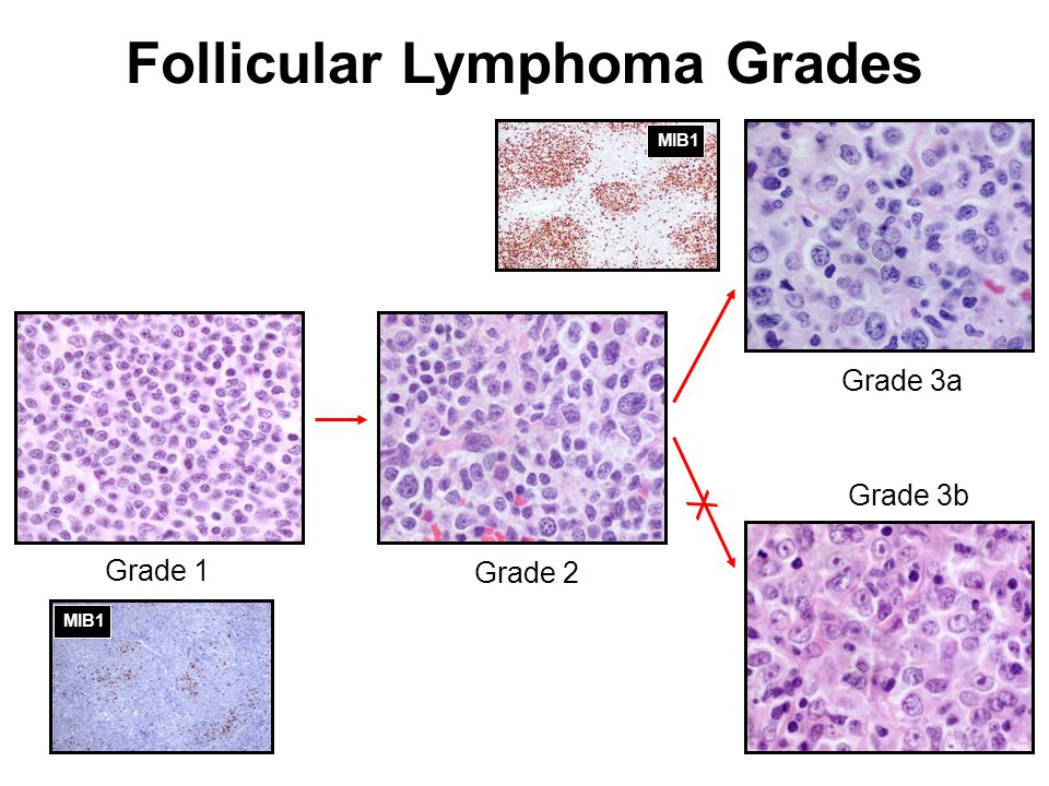 What is Follicular Lymphoma Grade 1 and What Can Be Done About It?
