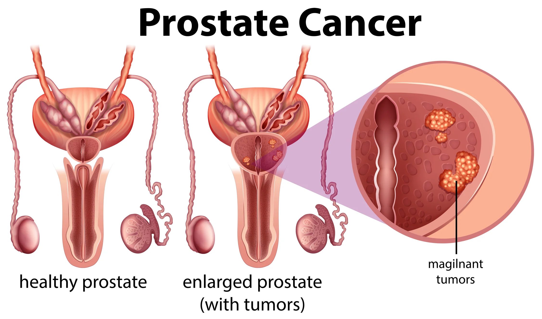 Prostate Cancer Warning: 7 Early Signs You Should Never Ignore & How To Take Action