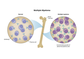 Exploring the Latest Advances in Multiple Myeloma Treatment