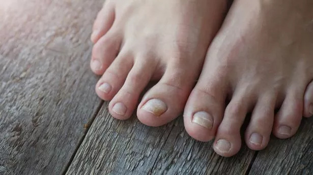 Understanding The Side Effects Of Psoriatic Arthritis