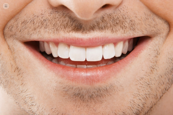 What to Know About Dental Implant Trials: A Participant's Guide