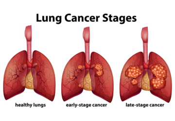 Early Signs of Lung Cancer? Don’t Ignore These Symptoms!
