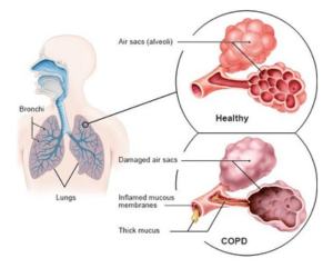 COPD Uncovered: Symptoms, Stages, and Solutions You Need to Know