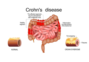 Fatigue and Fever: The Often Overlooked Symptoms of Crohn's