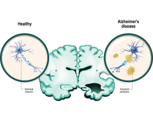 How to Tell If It’s Normal Aging or Alzheimer’s: Don’t Ignore These Signs
