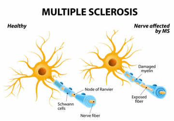 Recognizing Early Signs of Multiple Sclerosis and Emerging Cell Treatments