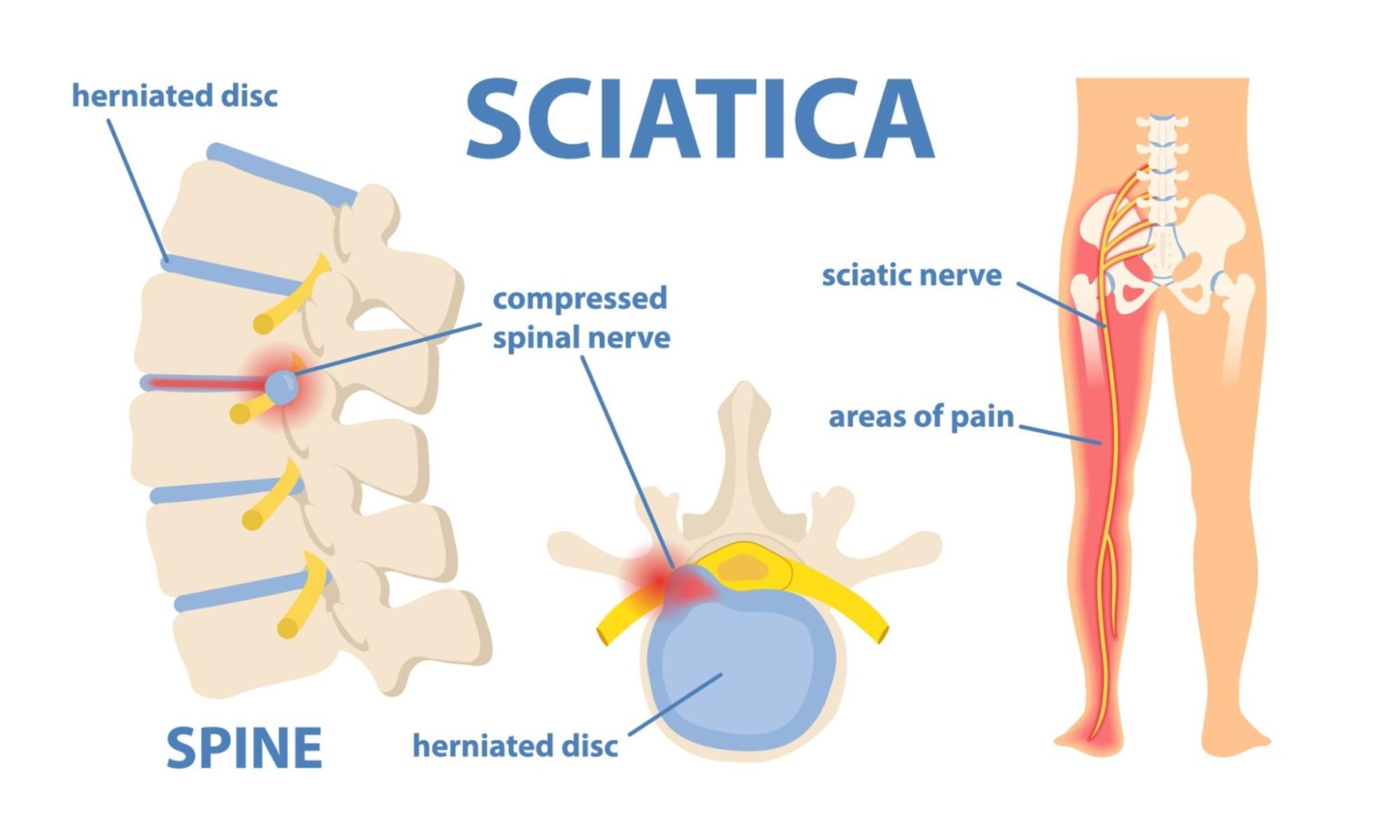 Understanding Sciatica: A Guide to Symptoms, Causes, and Care Options