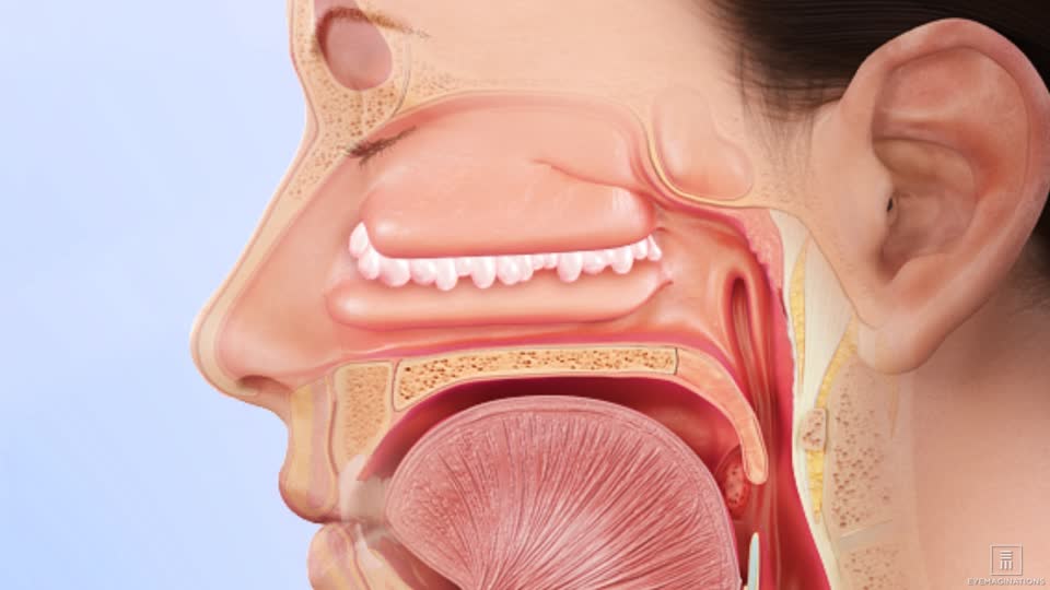 Nasal polyps – Symptoms, causes, and management