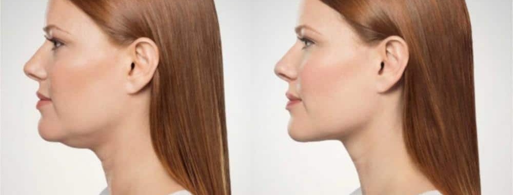 Understanding double chin removal: options and insights
