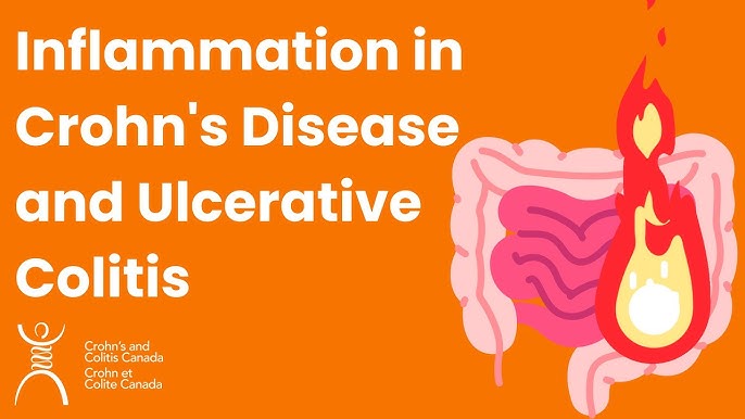 Understanding Ulcerative Colitis in the U.S.: Symptoms, Treatments, and Local Support