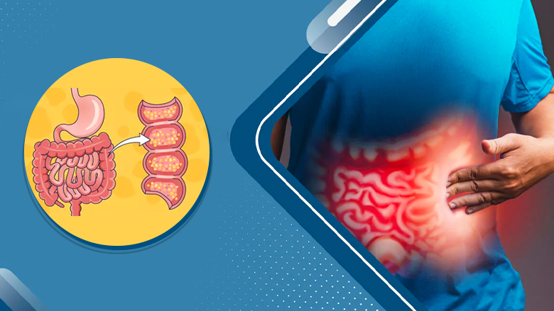 Learn about treatment options and management strategies for Crohn's disease