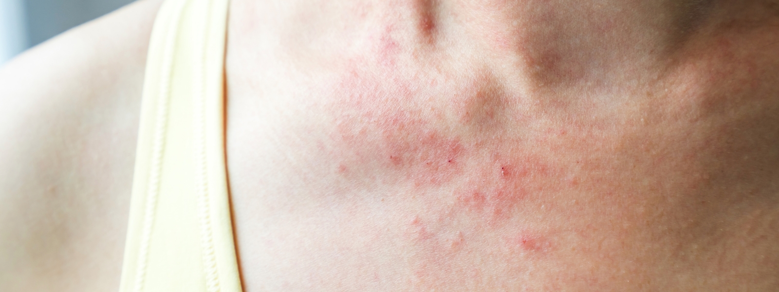 Allergy Treatment: Understanding Causes, Symptoms, and Management Strategies