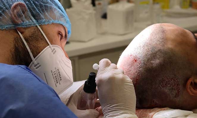 Things You Need to Know About Hair Transplantation