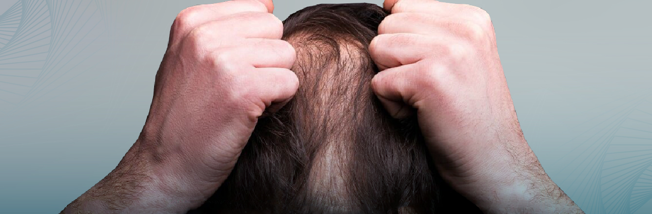 What you need to know about hair transplantation