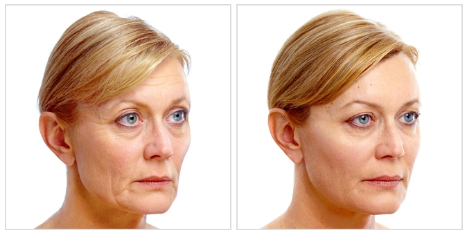 Clinics Are Seeking Individuals Interested in a Juvederm Facial Lift