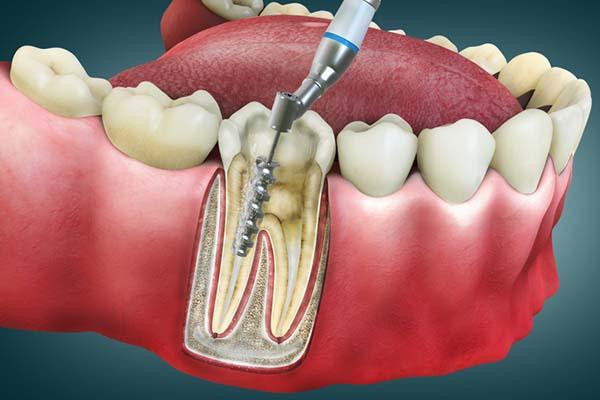 Root canal treatment explained: When is it needed, how much does it cost, and whether it is painful