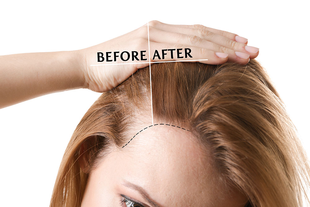 Regrow Confidence: Breakthrough Clinical Trials and Traditional Hair Transplants Explained