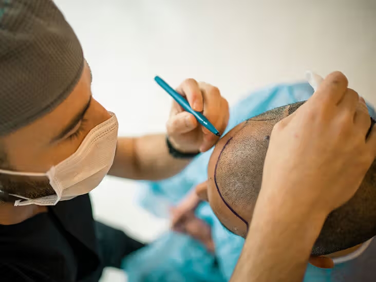 Affordable Hair Transplant Options in the U.S.: Discounts & Clinical Trial Opportunities