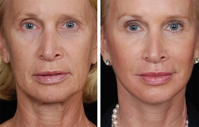 Rediscover Your Radiance: The Ultimate Guide to Rhytidectomy (Facelift)