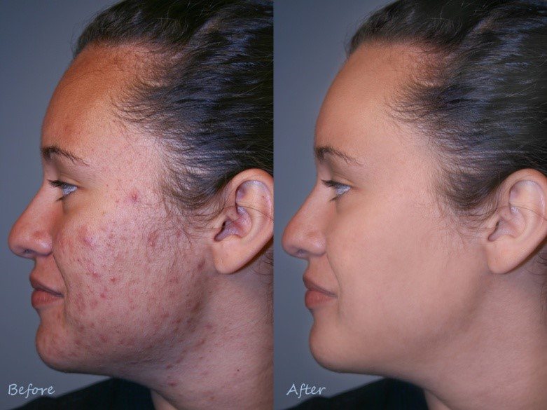Laser Acne Treatment in the U.S.: What You Need to Know
