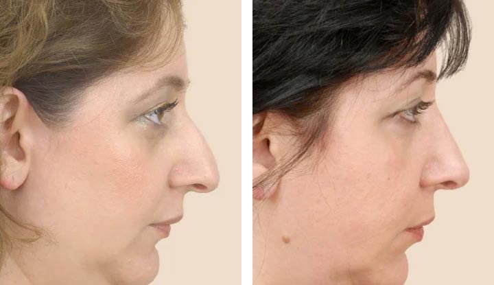 Nose correction: Get a discount and become more beautiful