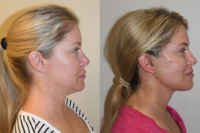 ¿Lifting facial costoso? Paga en cuotas con estas opciones