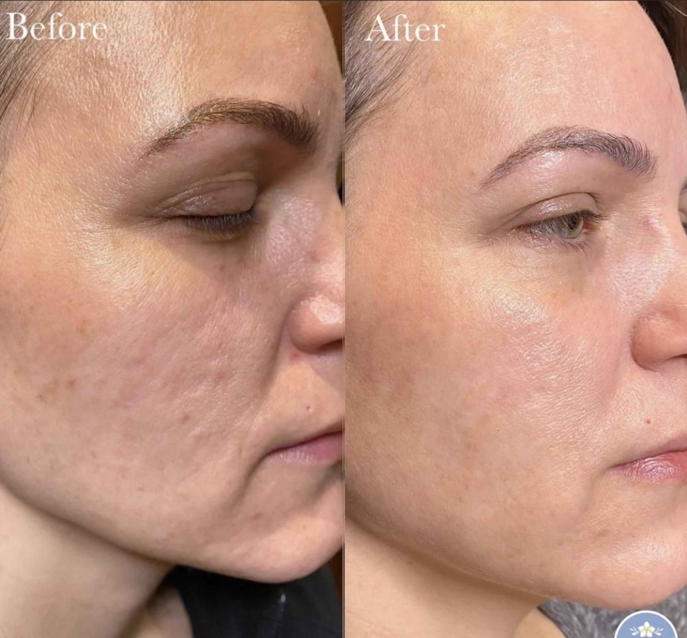 Radio Frequency Skin Tightening: A Non-Invasive Path to Firmer Skin