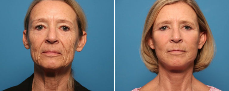 Facelifts Trials: A Low-Cost Pathway to Cutting-Edge Lifting Techniques