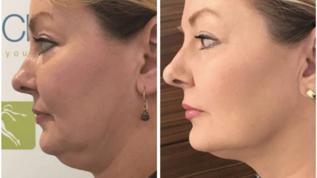 Ensayos de Lifting Facial: Una vía de bajo costo hacia técnicas de rejuvenecimiento de vanguardia