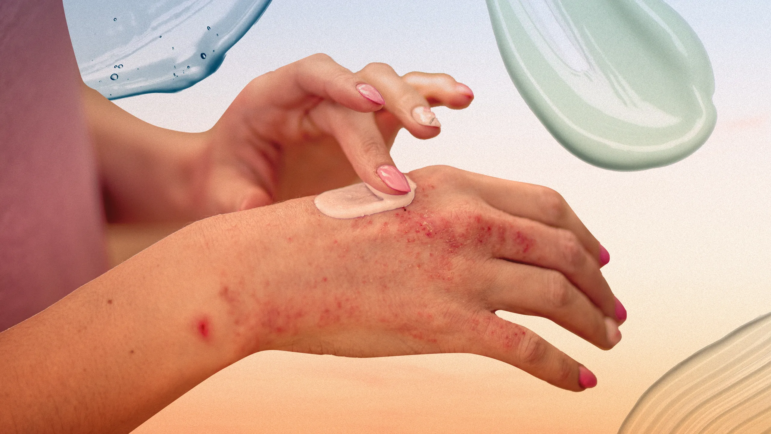 Psoriasis Treatment Uncovered: From Skincare to Cutting-Edge Biologics