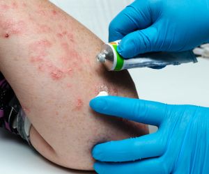 How do you get psoriasis? Is it contagious?