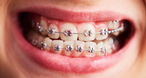 The rise of dental clips for teeth: What you need to know