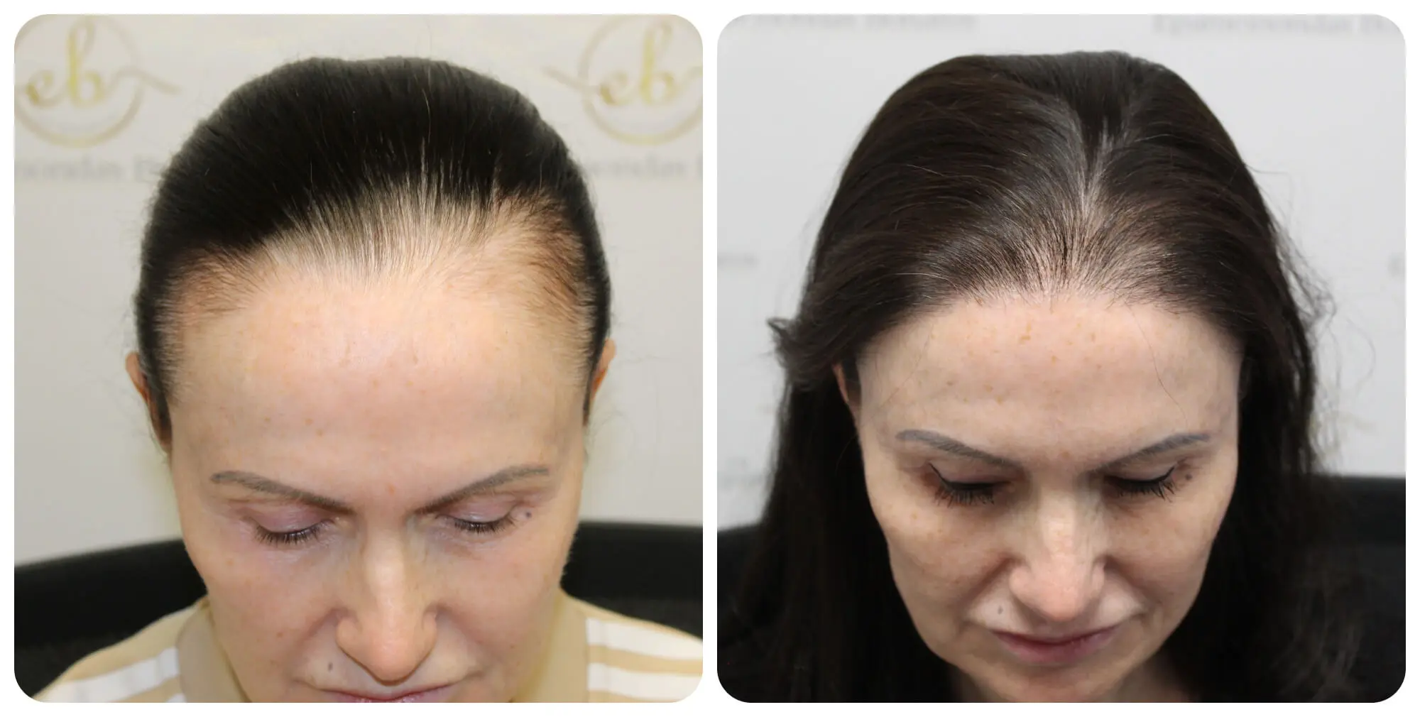 Hair Transplant: Restore Your Hair & Confidence. See Stunning Before & After Results!