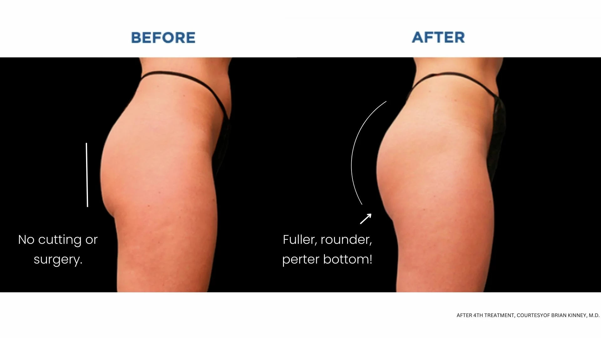 Bigger Butt Without Surgery: Non-Surgical Methods to Enhance Your Curves