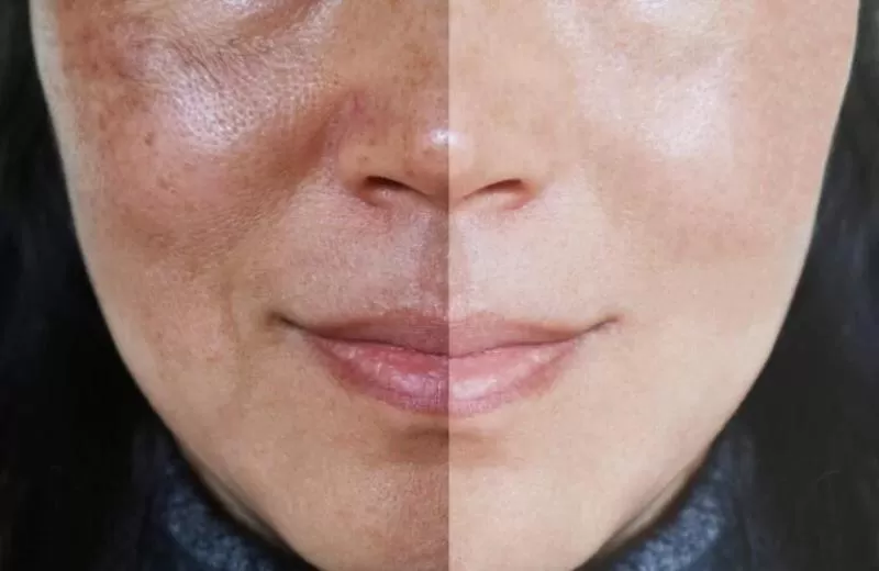 Melasma Treatment Near Me: Find the Best Options for Clearer Skin