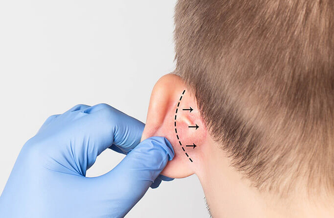 Understanding Otoplasty: A Comprehensive Guide to Ear Reshaping Surgery
