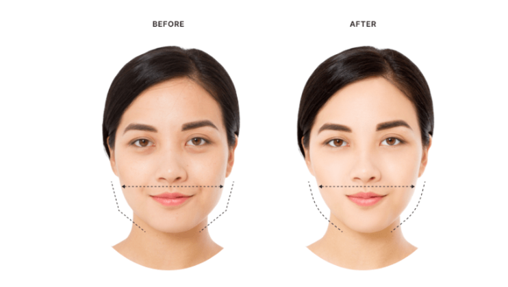 Masseter Botox: A Non-Surgical Solution for Jawline Slimming and Relief