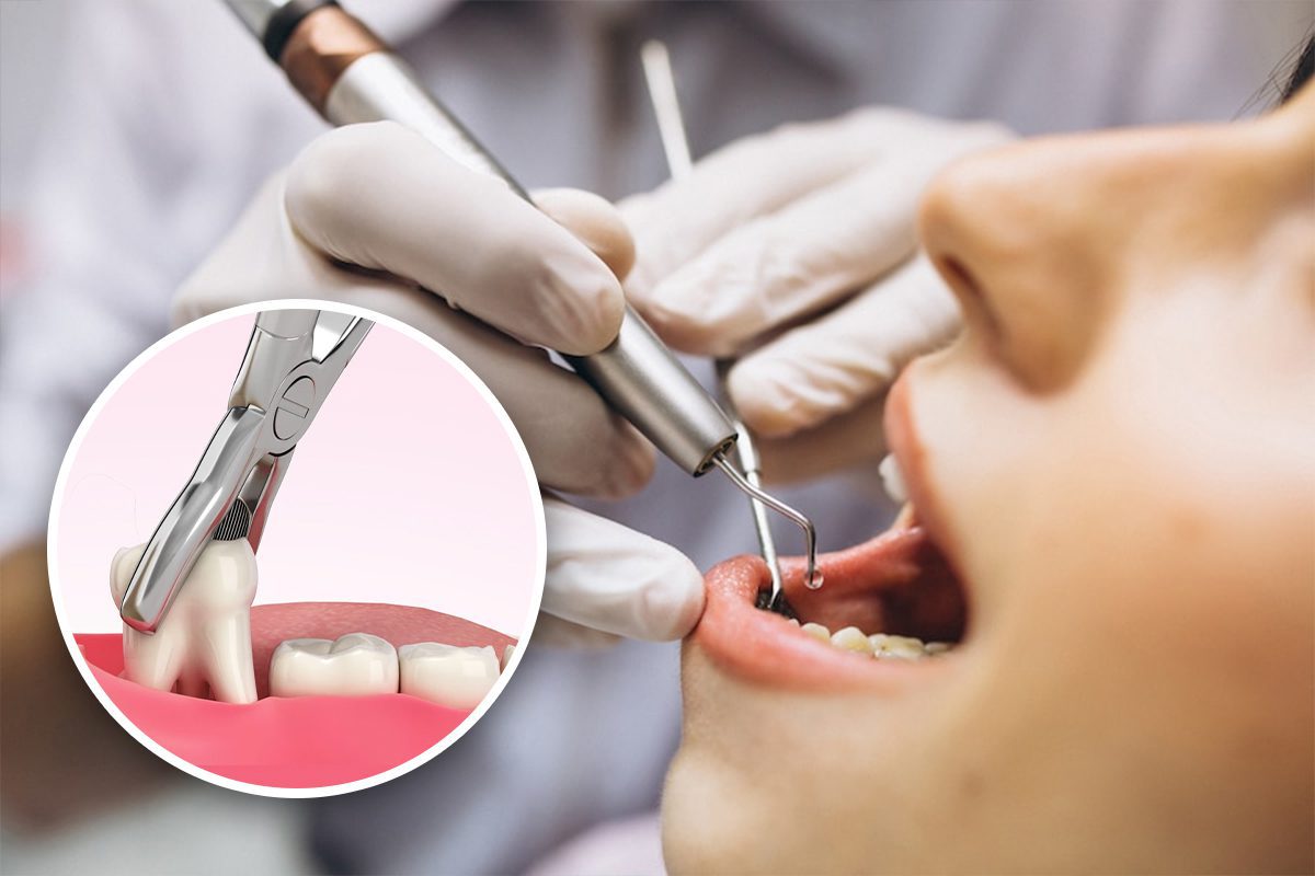 Wisdom Teeth Removal: What to Know Before You Get Them Out