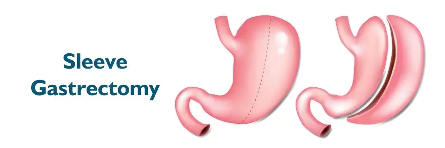 From Surgery to Recovery: A Practical Guide to Gastrectomy