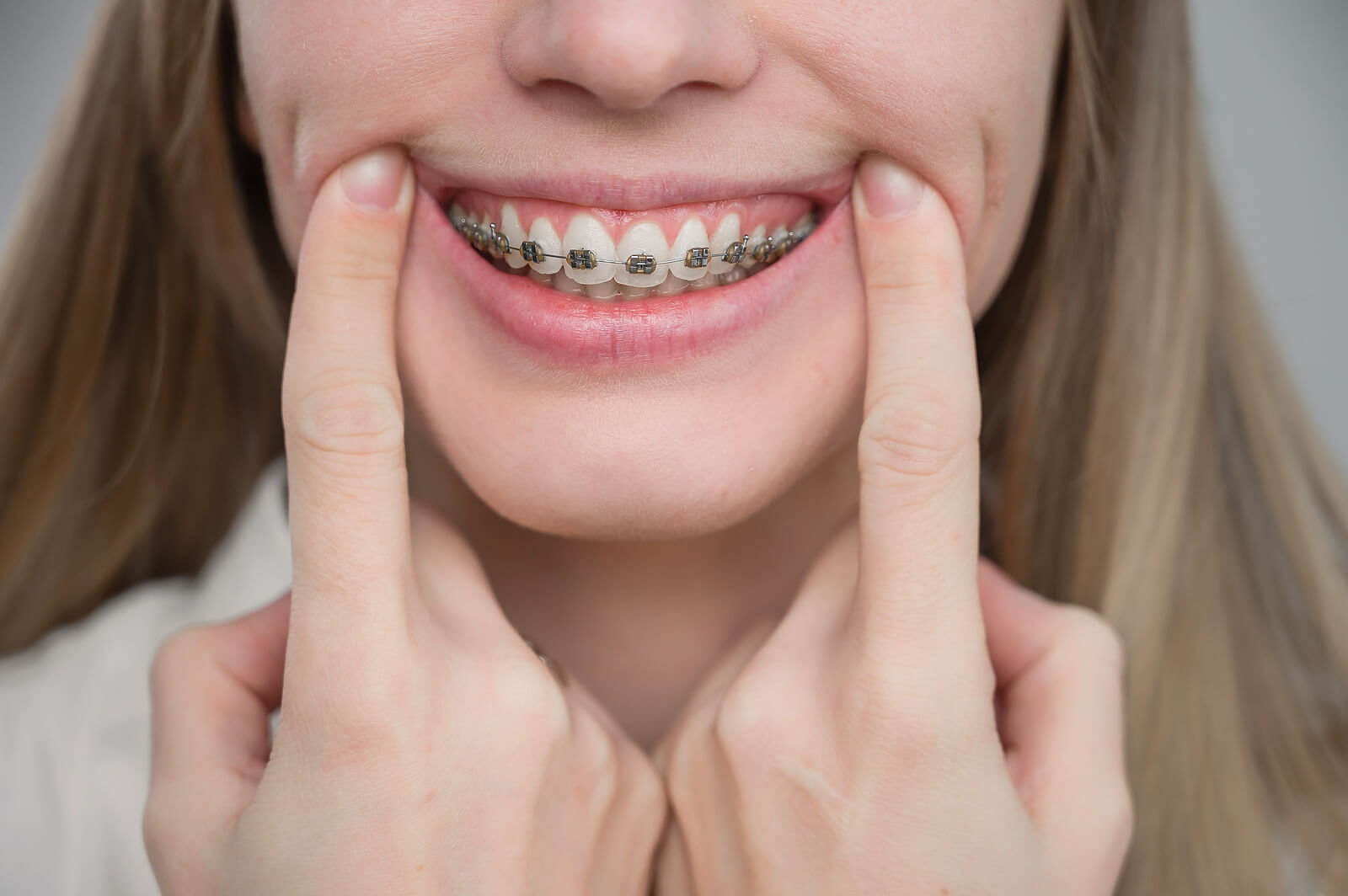 Braces in the United States — a practical guide 
