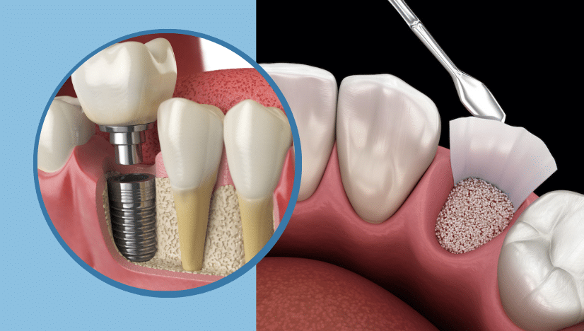 Do I Need a Dental Bone Graft?
